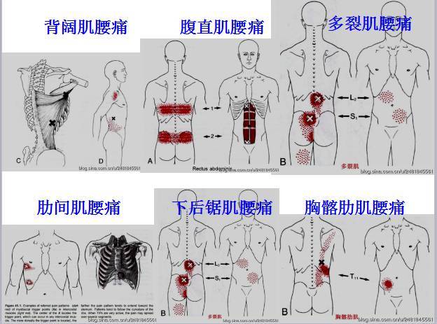 肌筋膜疼痛触发点全身分布图(头颈肩腰腿痛) 