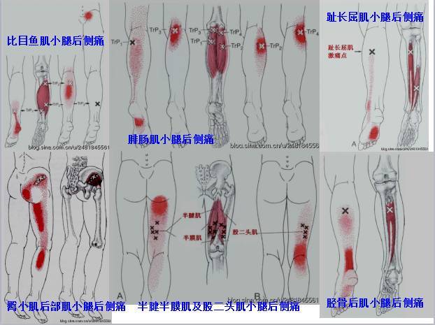 肌筋膜疼痛触发点全身分布图