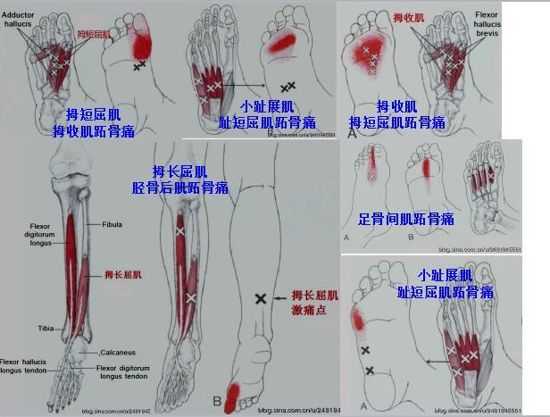 肌筋膜疼痛触发点全身分布图(头颈肩腰腿痛) - 好网角收藏夹