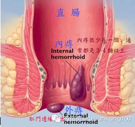 痔瘡,肛瘻,肛裂,直腸癌,肛周膿腫,腸炎等!