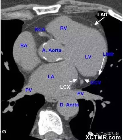心脏CT横断面解剖图图片