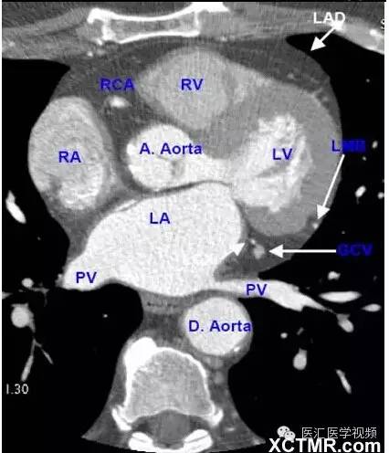 超全总结心脏ct解剖图谱