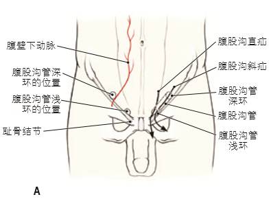 b 腹股沟斜疝由腹壁下血管外侧穿出腹腔并进 入腹股沟管;c