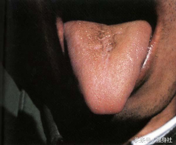 肝胆湿热舌苔表现图图片