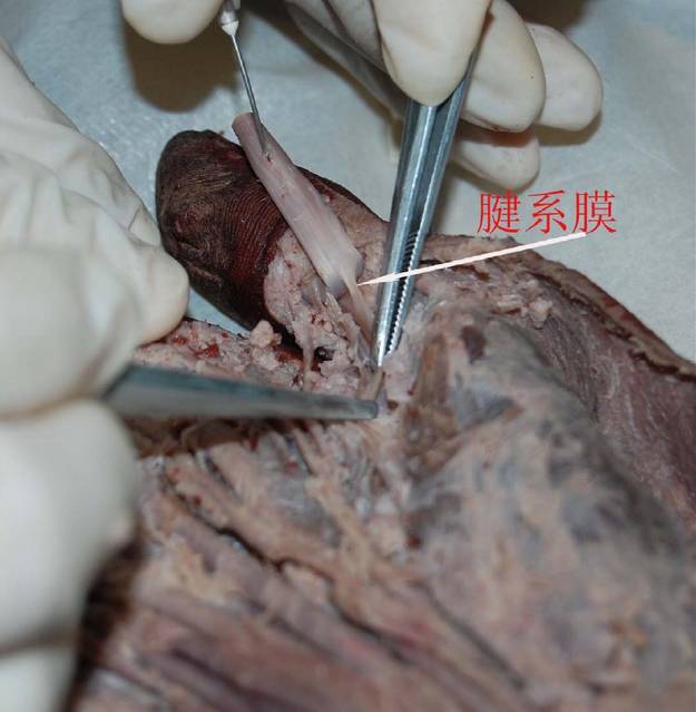 针刀治疗腱鞘炎--痛苦小,效果好(真人解剖)针刀必备 - 好网角收藏夹